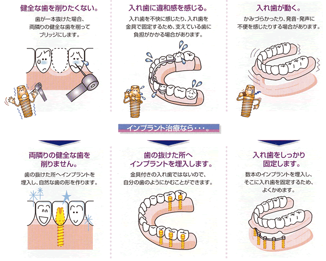 インプラントお薦め